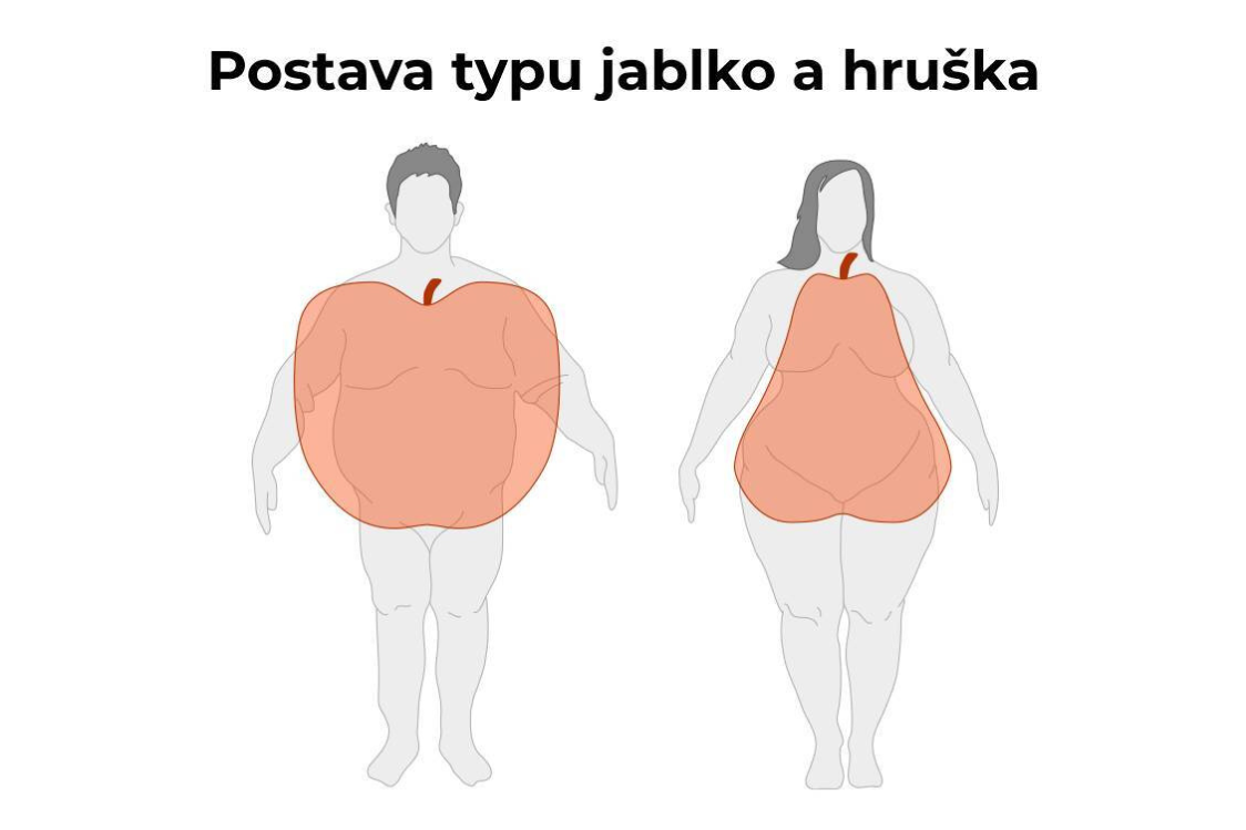 Androidní a gynoidní obezita Androidní a gynoidní obezita